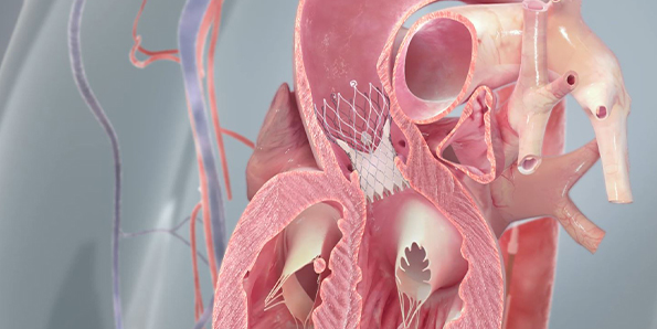 (TAVR) Transcatheter Aortic Valve Replacement 