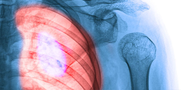 low-dose CT scan